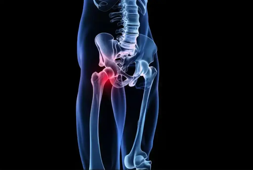 colo-do-femur
