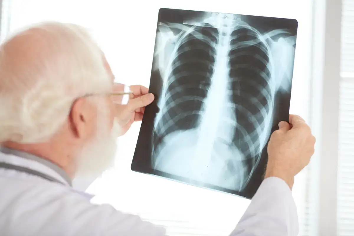 Pneumonia em Idosos Principais Sintomas e Como Tratar
